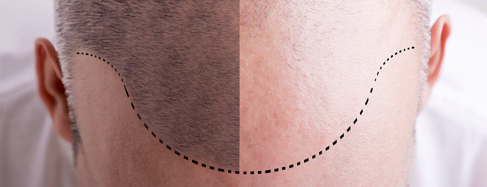 Trichobiolight – Rigenerazione innovativa